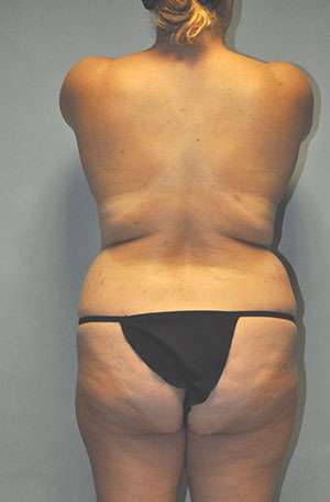 Abdominoplasty Case 5199 Before Photo Abdominoplasty