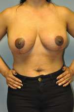 Mastopexy