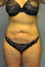 Abdominoplasty