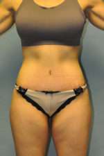 Abdominoplasty