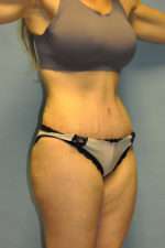 Abdominoplasty