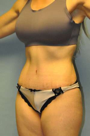 Abdominoplasty