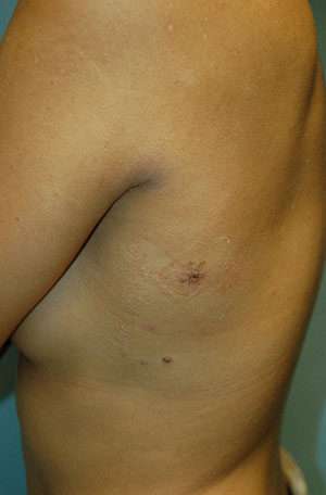 Minimal Incision and Power-assisted Liposuction Removal of Lipomas Case 5342 After Photo Minimal Incision and Power-assisted Liposuction Removal of Lipomas