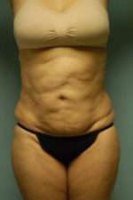 Abdominoplasty