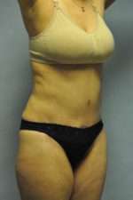 Abdominoplasty