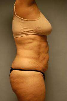 Abdominoplasty Case 5379 Before Photo Abdominoplasty