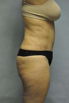 Abdominoplasty