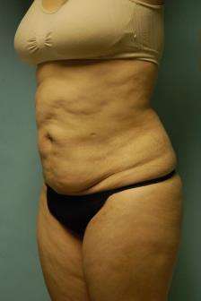 Abdominoplasty Case 5379 Before Photo Abdominoplasty