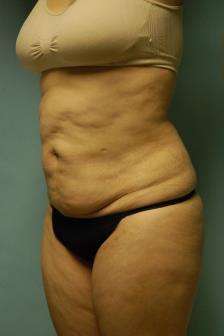 Abdominoplasty