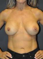 Breast Augmentation, Gel