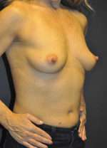 Breast Augmentation, Gel