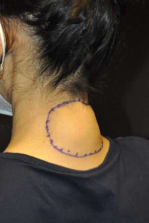 Minimal Incision and Power-assisted Liposuction Removal of Lipomas Case 17331 Before Photo Minimal Incision and Power-assisted Liposuction Removal of Lipomas