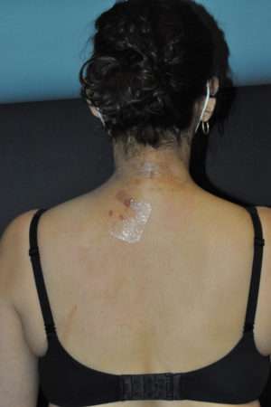Minimal Incision and Power-assisted Liposuction Removal of Lipomas Case 17331 After Photo Minimal Incision and Power-assisted Liposuction Removal of Lipomas