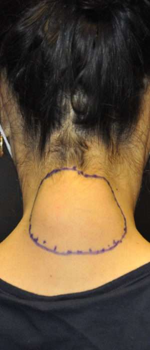 Minimal Incision and Power-assisted Liposuction Removal of Lipomas Case 17331 After Photo Minimal Incision and Power-assisted Liposuction Removal of Lipomas