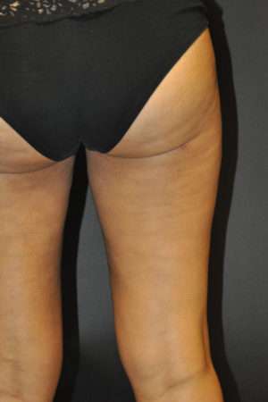 Cellulaze Anti-cellulite Treatment