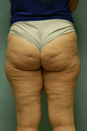 Cellulaze Anti-cellulite Treatment