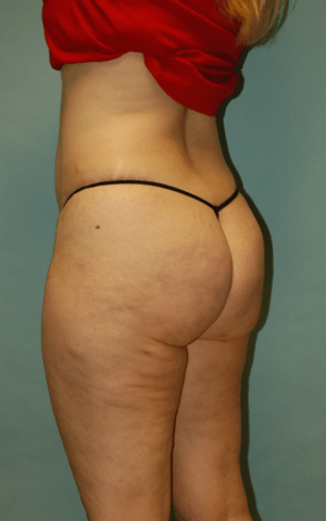 Cellulaze Anti-cellulite Treatment