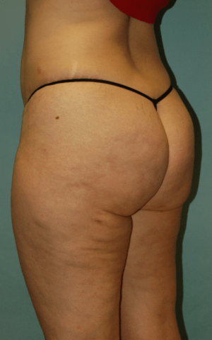 Cellulaze Anti-cellulite Treatment