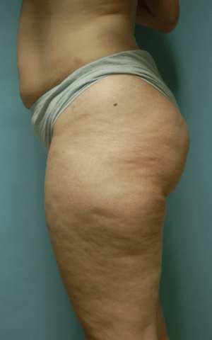 Cellulaze Anti-cellulite Treatment