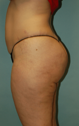 Cellulaze Anti-cellulite Treatment