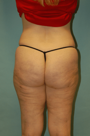 Cellulaze Anti-cellulite Treatment