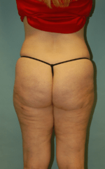 Cellulaze Anti-cellulite Treatment