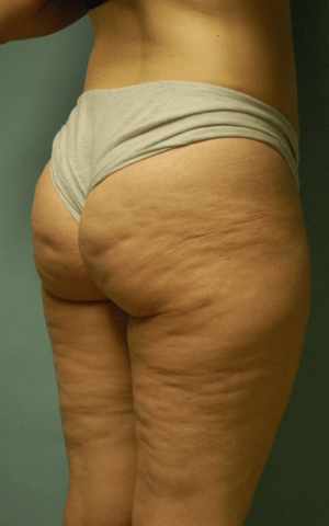 Cellulaze Anti-cellulite Treatment