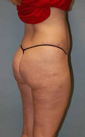 Cellulaze Anti-cellulite Treatment