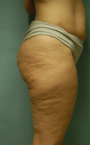 Cellulaze Anti-cellulite Treatment