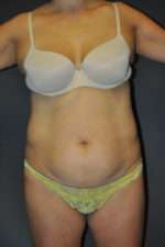 Abdominoplasty