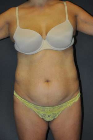 Abdominoplasty