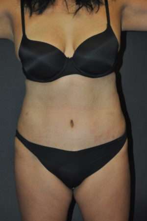 Abdominoplasty