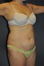 Abdominoplasty