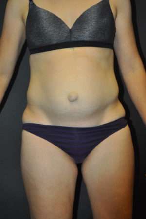 Abdominoplasty