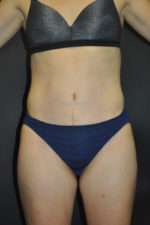 Abdominoplasty