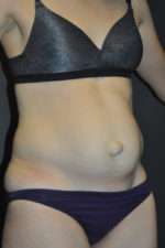 Abdominoplasty