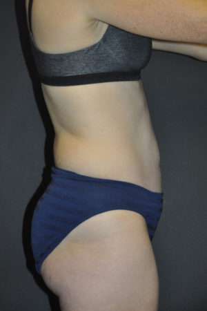 Abdominoplasty