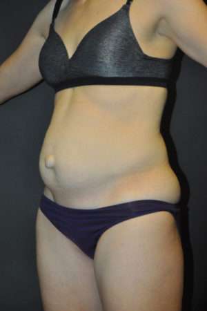 Abdominoplasty