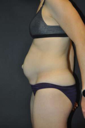 Abdominoplasty