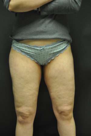 Cellulaze Anti-cellulite Treatment