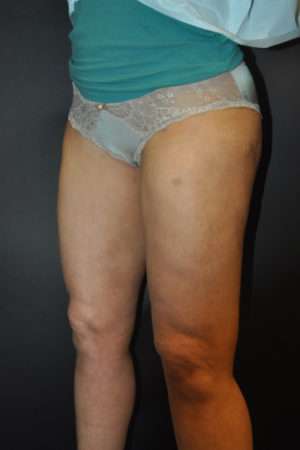 Cellulaze Anti-cellulite Treatment