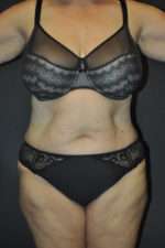 Abdominoplasty