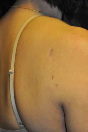 Minimal Incision and Power-assisted Liposuction Removal of Lipomas