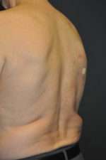 Minimal Incision and Power-assisted Liposuction Removal of Lipomas