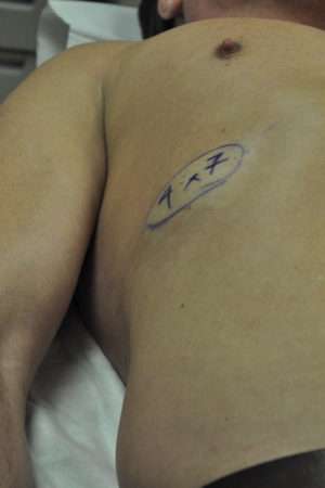 Minimal Incision and Power-assisted Liposuction Removal of Lipomas