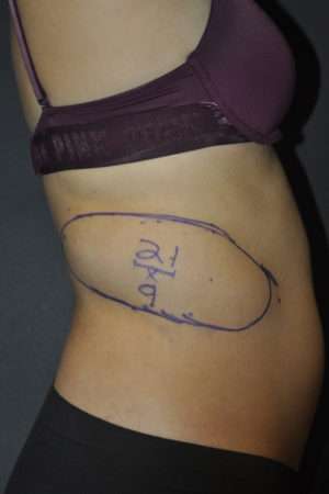 Minimal Incision and Power-assisted Liposuction Removal of Lipomas