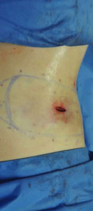 Minimal Incision and Power-assisted Liposuction Removal of Lipomas