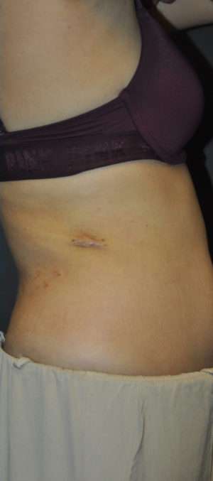 Minimal Incision and Power-assisted Liposuction Removal of Lipomas