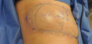 Minimal Incision and Power-assisted Liposuction Removal of Lipomas