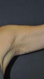 Minimal Incision and Power-assisted Liposuction Removal of Lipomas